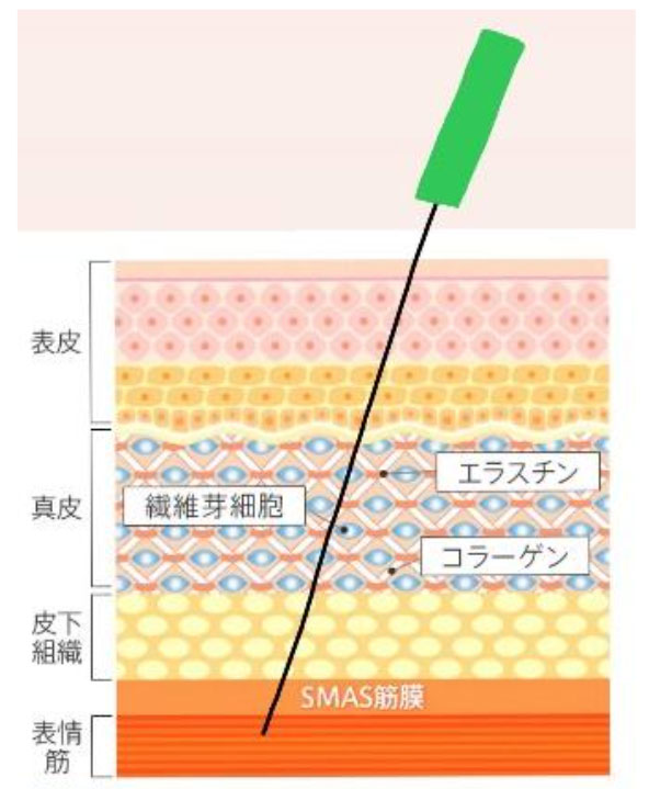 リフトアップ効果に最適な刺入深度