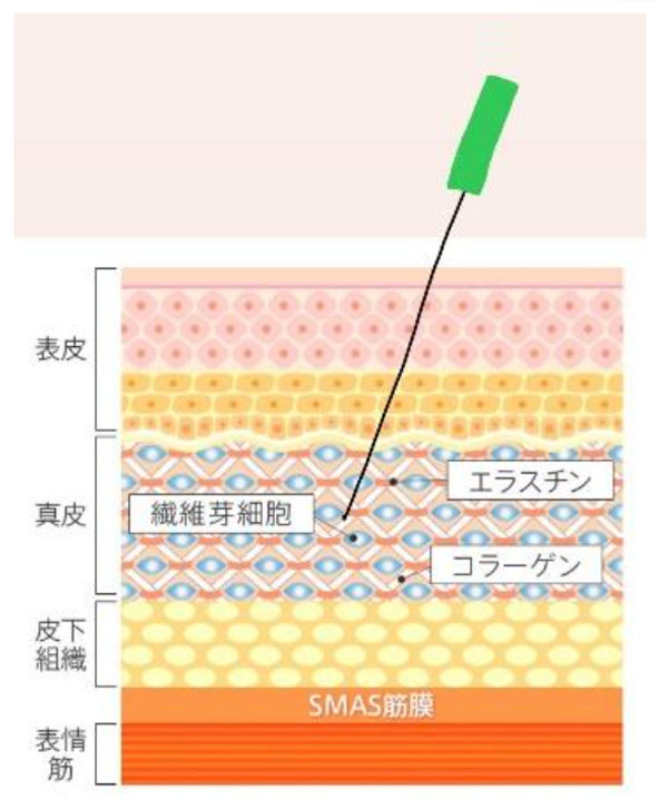 肌質改善に最適な刺入深度